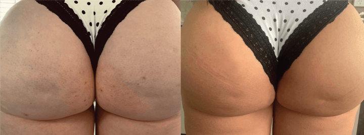 Folliculitis and bumps before and after