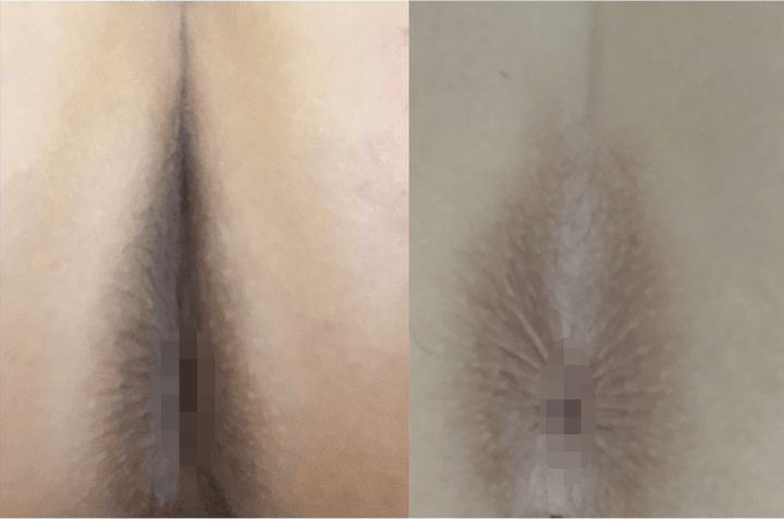 Butt crack and anal area