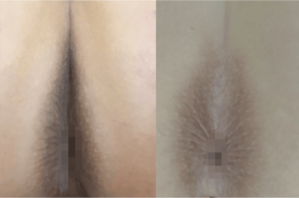 Before and after results