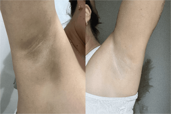 Before and after results