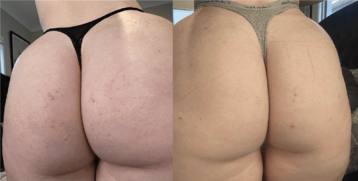 Persistent bumps before and after