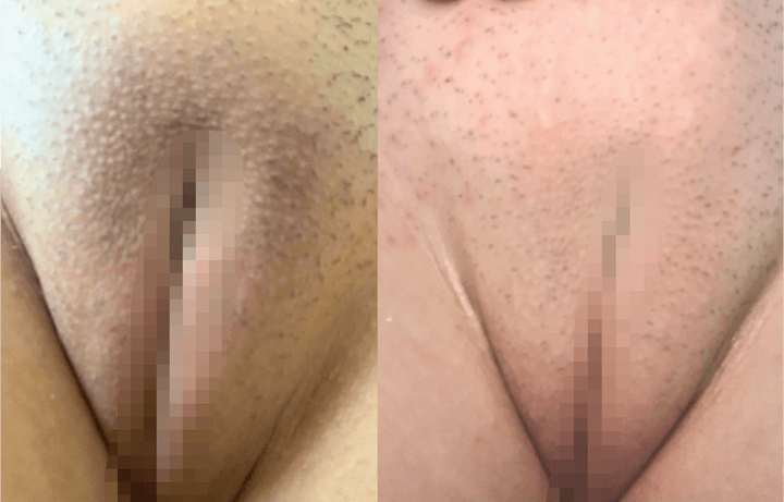 Labia and bikini line