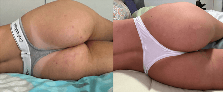 Breakouts and texture before and after