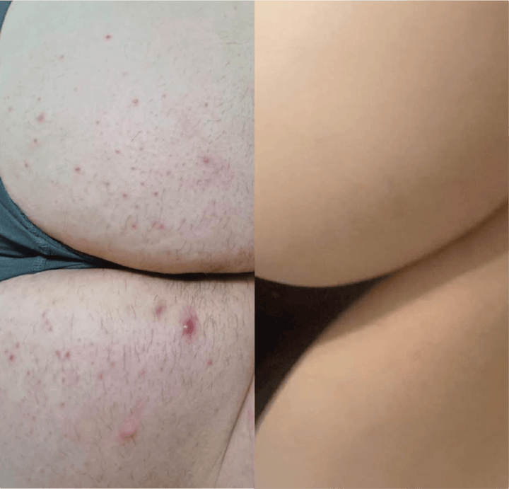 Severe folliculitis before and after