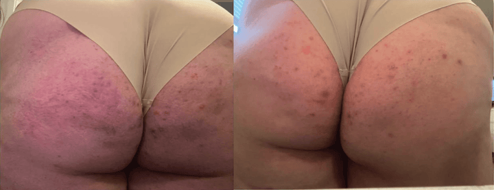Inflammation and redness before and after
