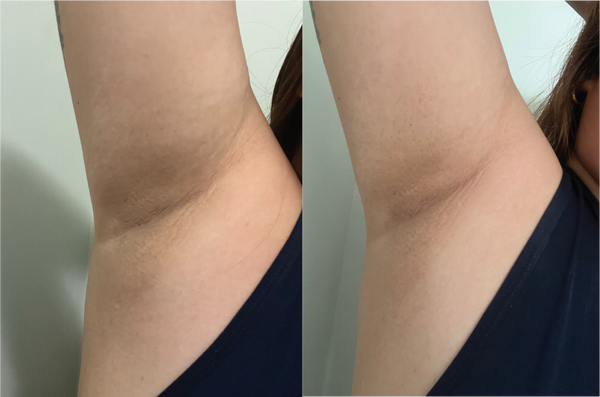 Before and after results