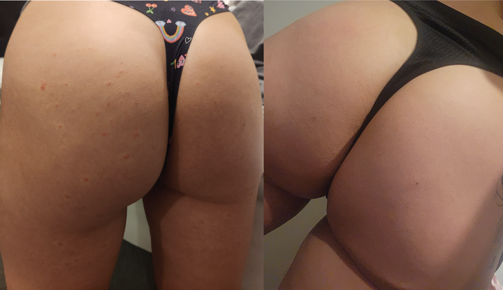 Breakouts and scarring before and after